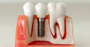 Dental Implants Dental Implants